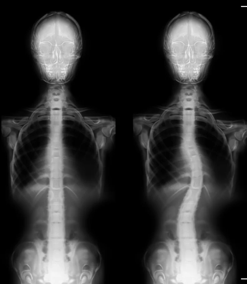 Scoliosis Matthews
